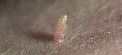 penisdəki papilloma necə çıxarılır