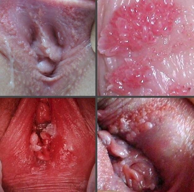 Vajinada papillomaların yaxınlaşması